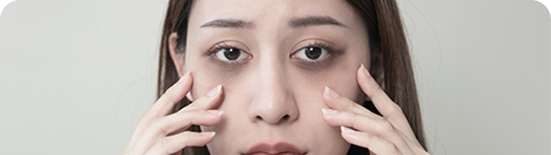 Kobieta z ciemnymi cieniami pod oczami, dotykająca palcami policzków, wyrażająca zmęczenie